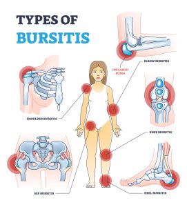 What is bursitis?