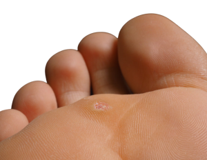 What are plantar warts?