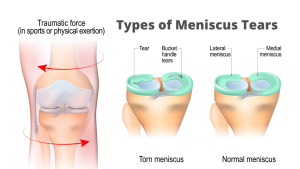 What is a meniscus tear?